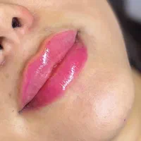 افرفیلرلب صورت لیزرکندلاساکشن غبغب بلفاروتهرانسر