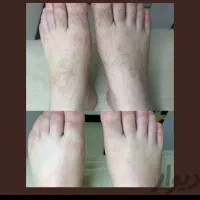 نیازمند سالندار برای کار لیزر