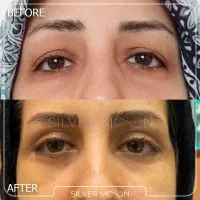 جشنواره پاییزه جراحی زیبایی پلک(بلفاروپلاستی)|خدمات آرایشگری و زیبایی|تهران, قیطریه|دیوار