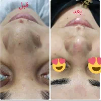 خاویار تراپی همراه با پاکسازی پوست و فشیال تخصصی|خدمات آرایشگری و زیبایی|شیراز, سفیرشمالی|دیوار