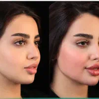 فول فیس ژل لب فیلربیکینی تخفیفات فقط دو روز|خدمات آرایشگری و زیبایی|مشهد, احمدآباد|دیوار