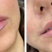 تزریق فیلر و بوتاکس توسط پزشک در کلینیک زیبایی|خدمات آرایشگری و زیبایی|قم, نیروگاه|دیوار