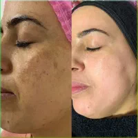 با روزی ۲۸ هزار تومن پوستتو شفاف کن