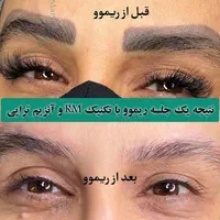 ریموو تتو ابرو و چشم، میکروبلید(فیبروز)، شیدینگ لب