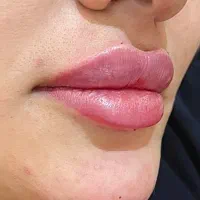 تزریق ژل و بوتاکس، نخ، مزو، فیلربادی|خدمات آرایشگری و زیبایی|ری, اقدسیه|دیوار