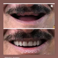 دندانسازی سکندری کرمان دندان ایتالیایی لثه نرم|خدمات آرایشگری و زیبایی|کرمان, |دیوار