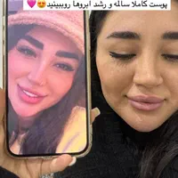 حذف تتو،کک و مک،ماه گرفتگی و روشن سازی بدن با لیزر|خدمات آرایشگری و زیبایی|قزوین, |دیوار