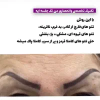 ریموو تتو در یک جلسه با متریال برند|خدمات آرایشگری و زیبایی|بهار, |دیوار