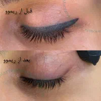 ریموو تتو ابرو و چشم، میکروبلید(فیبروز)، شیدینگ لب