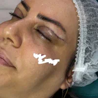 بلفارو پلاستی بدون جای بخیه تضمینی و فیلر و بوتاکس|خدمات آرایشگری و زیبایی|تبریز, |دیوار