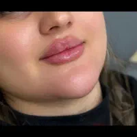 تزریق ژل و بوتاکس برازجان