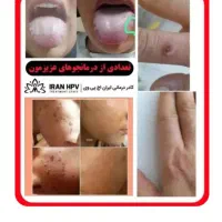 بهبود زگیل/تبخال/hpv/hsv|آرایشی، بهداشتی، درمانی|قم, یخچال قاضی|دیوار