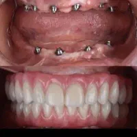 مرکز تخصصی ایمپلنت دیجیتال..