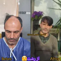 کاشت مو طبیعی در شیراز و فسا*