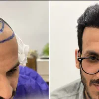کاشتمو و میکروکاشت ابرو