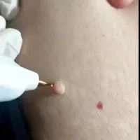 خدمات آرایشی ازجمله خال برداری منگوله گوشتی  ،