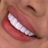 کامپوزیت دندان،روکش،لمینت،اموزش کامپوزیت|خدمات آرایشگری و زیبایی|فردیس, فردیس|دیوار