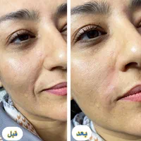 جشنواره تزریق ژل و بوتاکس (تحت نظرپزشک)|خدمات آرایشگری و زیبایی|اصفهان, خلجا|دیوار