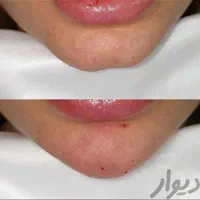 لیزرموهای زائد،ژل لب فول فیس زاویه مزوبوتاکس هایفو|خدمات آرایشگری و زیبایی|مشهد, آزادشهر|دیوار