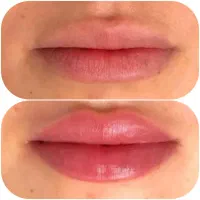 جشنواره prp و مزوتراپی ( آقایان و بانوان)|خدمات آرایشگری و زیبایی|بروجرد, |دیوار