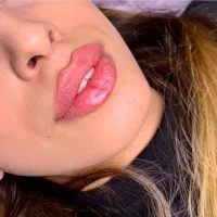 افر استثنایی فیلر بادی،بوتاکس،کانتورینگ،ژل مزوژل