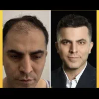 کاشت مو فقط 6 میلیون تومان به مدت محدود|خدمات آرایشگری و زیبایی|شیراز, زرگری|دیوار