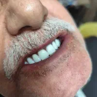 دندان مصنوعی هر فک ۶ تومان وارداتی