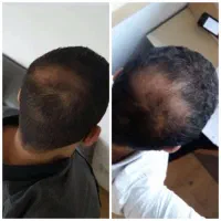 بازگشت پرپشتی مو