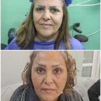 کوچک کردن و لیفت شکم و سینه توسط متخصص در یاسوج