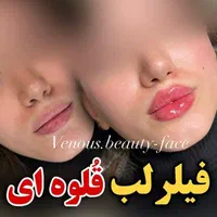 تزریق ژل لب روسی390بوتاکس/پروفایلو/مادلینگ/لیزر|خدمات آرایشگری و زیبایی|تهران, طرشت|دیوار