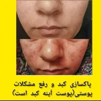 درمان کبد چرب تا گرید1/گرید۲/گرید۳ در۳۰روز|خدمات آرایشگری و زیبایی|آزادشهر, |دیوار