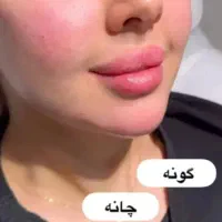 ژل،فیلربادی،بیکینی،بوتاکسprp لیفت صورت|خدمات زیبایی و سلامت|تبریز, |دیوار