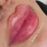 تخفیف استثنایی خدمات ژل فیلر بوتاکس|خدمات آرایشگری و زیبایی|کرج, گلشهر|دیوار