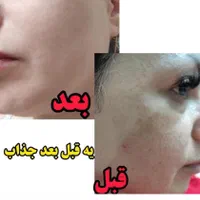 تنها نمایندگی کرم ضد لک لاکچری کوین(اصلی)|آرایشی، بهداشتی، درمانی|مشهد, توس (بلوار توس)|دیوار