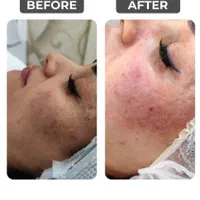 پاکسازی،مزونیدلینگ،برداشتن کک ومک،پیرسینگ+آموزش|خدمات آرایشگری و زیبایی|مشهد, سجاد شهر|دیوار