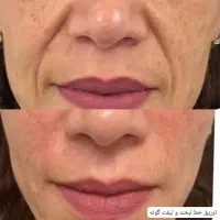 جشنواره یلدایی ژل / بوتاکس / جوانساز صورت(در مطب)|خدمات آرایشگری و زیبایی|شاهین‌شهر, فردوسی|دیوار