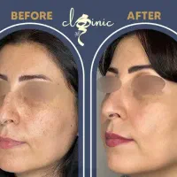 کرم برای لک،جوش، جای جوش، تیرگی و کلاژن ساز