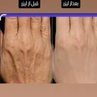 الکترولیز موی سفید وبرداشتن خال و زگیل ومیخچه|خدمات آرایشگری و زیبایی|یاسوج, |دیوار
