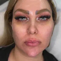 تزریق ژل و بوتاکس فیلر بادی