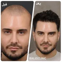 کاشت مو پرتراکم با تکنیک جدید و طراحی لیزری