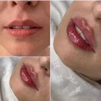 فیلر بادی هیپ دیپ ژل بوتاکس