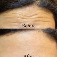 اف ویژه ژل بوتاکس بندرعباس|خدمات آرایشگری و زیبایی|بندرعباس, |دیوار