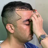 کاشت مو شقیقه با موی بلند /نتیجه روز عمل