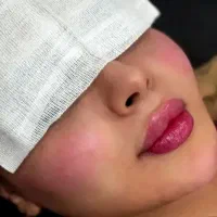 ژل و بوتاکس
