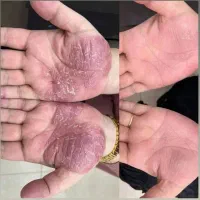 درمان قطعی و بدون بازگشت مشکلات پوستی|خدمات آرایشگری و زیبایی|مشهد, کلاهدوز|دیوار