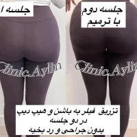 تزریق ژل لب فیلر بوتاکس لیفت فیلربادی کانتورینگ|خدمات آرایشگری و زیبایی|تهران, مرزداران|دیوار