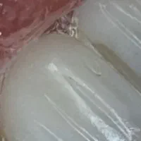 زیباترین کامپوزیت بدون هیچ پرداخت اولیه