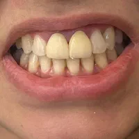 پروتز دندان ثابت و متحرک