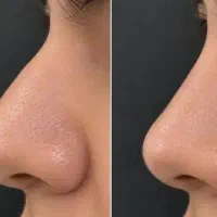 کوچک کردن بینی فقط تو ۲۰روز