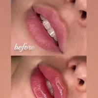 تخفیفات ۴۰٪فیلر بوتاکس ژل مزو،واقساط توسط دکتر